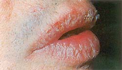 Сухая форма эксфолиативного хейлита. Корочки отсутствуют, наблюдаются сухие чешуйки.