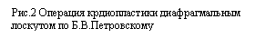 Подпись: Рис.2 Операция крдиопластики диафрагмальным лоскутом по Б.В.Петровскому