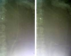 Ретроградные уретеропиелограммы слева