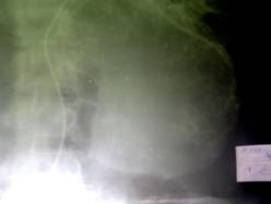 Артериограмма левой почки