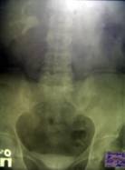 Выделительная урограмма с нисходящей цистограммой