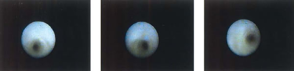 На ряде снимков, выполненных при эндоскопическом исследовании семявыносящего протока, показаны полая игла и характерная спиралевидная структура протока. Также видны белые пятна семенной жидкости.