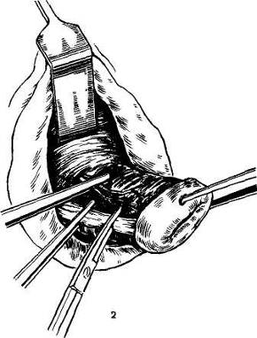 влагалищная экстирпация