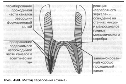 рентген зуба в канале инструмент. особенности инструментальеой обраьотки плохо проходисвз каналры. плохо запломбированный канал. плохо проходимых каналов. эндодонтические инструменты для прохождения корневого канала.