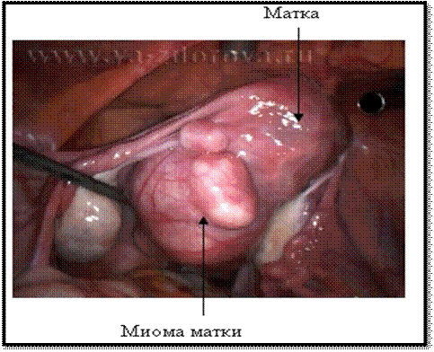 Реферат: Современные возможности патогенетического лечения железодефицитной анемии у больных с миомой матки