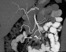 Реферат: Интраскопия (Ультразвуковая доплерография магистральных артерий мозг