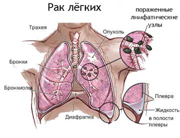 Реферат: Рак легкого