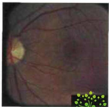 Клиническая картина осложненной близорукости