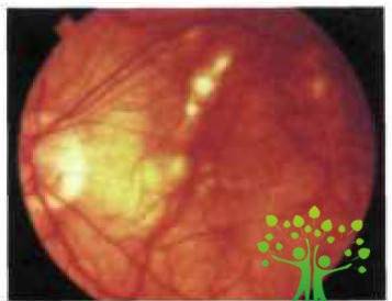 Клиническая картина осложненной близорукости