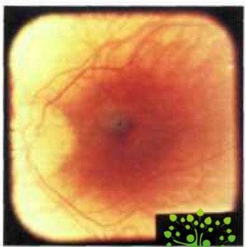 Клиническая картина осложненной близорукости