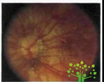 Клиническая картина осложненной близорукости