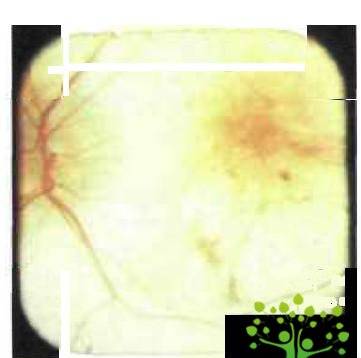 Клиническая картина осложненной близорукости