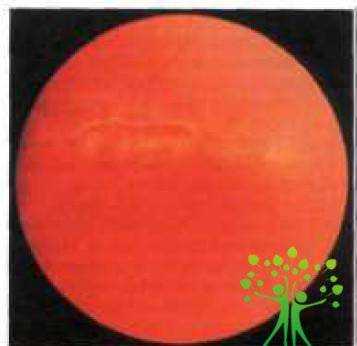 Клиническая картина осложненной близорукости