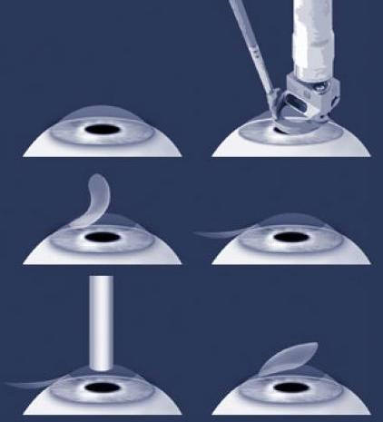 Лазерная коррекция зрения