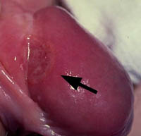 первичный сифилис (шанкр)