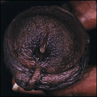 хламидиоз, диагностика, профилактика, лечение, хламидиоза, признаки, у мужчин, у женщин, хламидия, Chlamydia trachomatis, оральный секс, проктит, конъюнктивит, бытовое, заражение, хламидиозом, инкубационный период, выделения, из влагалища, из мочеиспускательного канала, боль, при мочеиспускании, осложнения, распространенность, пцр, ифа, пиф