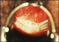 трихомониаз, трихомонада, Trichomonas vaginalis, признаки, диагностика, лечение, профилактика, трихомониаза, заражение, инкубационный период, выделения, из влагалища, из мочеиспускательного канала, боль, при мочеиспускании, при половом акте, анальный, оральный секс, осложнения, простатит, пиф, пцр, посев