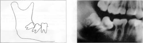 Альвеолярная пиорея латынь. Пародонтит и пародонтоз. Периодонтальный пародонтит. Медиально наклоненный ретинированный третий моляр. Альвеолярная пиорея латынь.