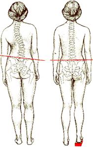 Искривление позвоночника (сколиоз)