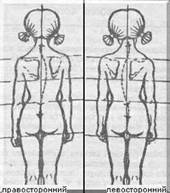 грудной сколиоз