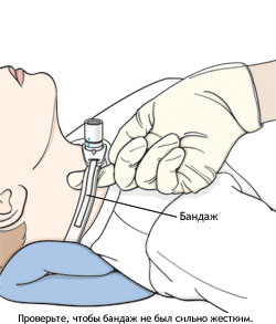 замена трахеостомы у детей