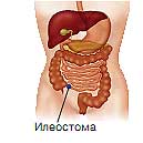 Илеостома - отверстие в области подвздошной кишки