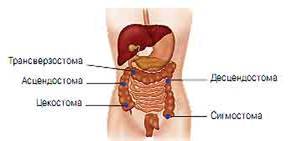 УХОД ЗА ПАЦИЕНТОМ СО СТОМОЙ КИШЕЧНИКА
