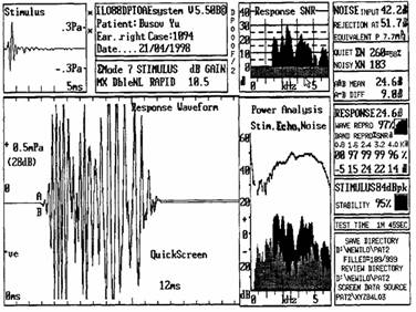 Рис. 3. Отоакустическая эмиссия, зарегистрированная у новорожденного с нормальным слухом.