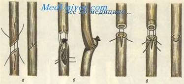 Шов мочеточника