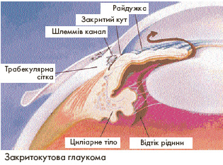 Закритокувата глаукома