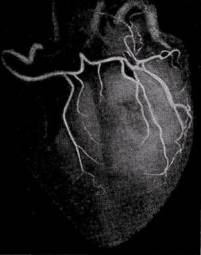 правовенечный тип коронарного кровообращения, хорошо развиты задние межжелудочковые ветви