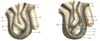 Косая паховая грыжа. Врожденные паховые грыжи.