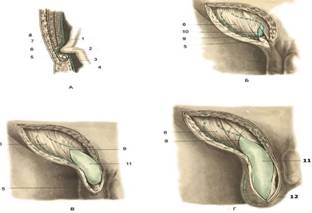 Приобретенная косая паховая грыжа. Классификация паховых грыж