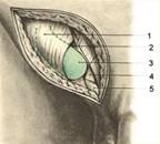 Околопаховая грыжа.