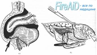 Скользящая грыжа. Что такое скользящие грыжи?