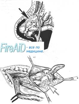 Скользящая грыжа. Что такое скользящие грыжи?