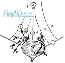 Надпузырная грыжа. Наружные и внутренние надпузырные грыжи.