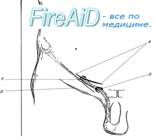 Выделение грыжевого мешка.