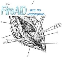 Выделение грыжевого мешка.