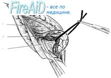 Выделение грыжевого мешка.