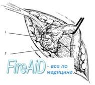 Выделение грыжевого мешка.