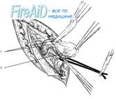 Выделение грыжевого мешка.