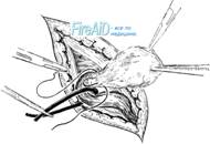 Варианты обработки грыжевого мешка.