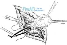 Варианты обработки грыжевого мешка.