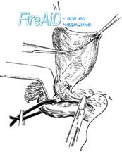 Варианты обработки грыжевого мешка.