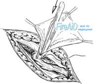 Варианты обработки грыжевого мешка.