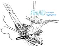 Варианты обработки грыжевого мешка.