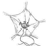 Варианты обработки грыжевого мешка.