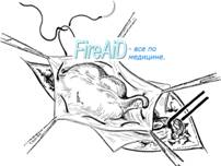 Обработка грыжевого мешка при скользящих грыжах по методу Zimmerman ( Зимерман ).
