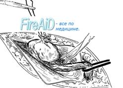 Обработка грыжевого мешка при скользящих грыжах по методу Zimmerman ( Зимерман ).